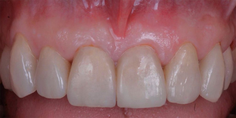 Carillas de composite