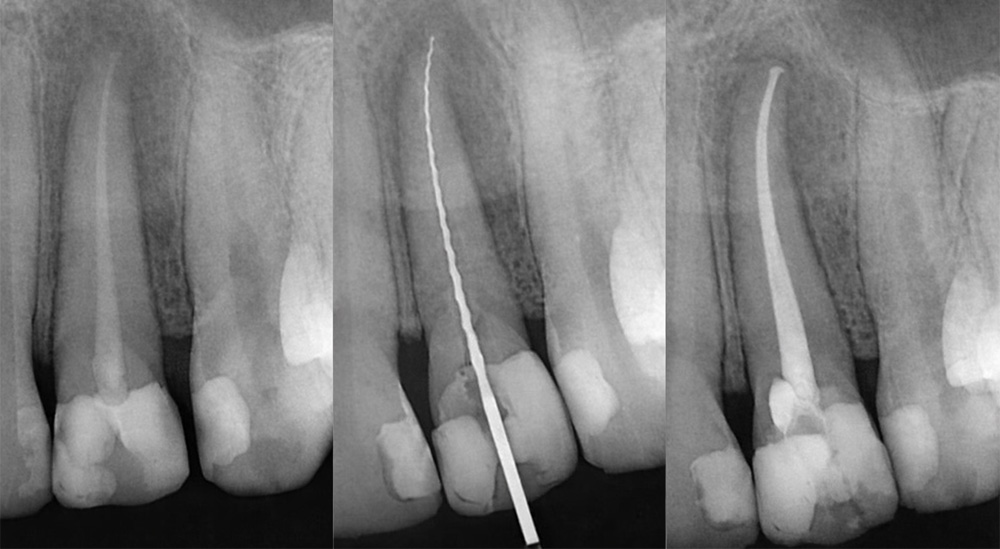 Tratamiento de endodoncia