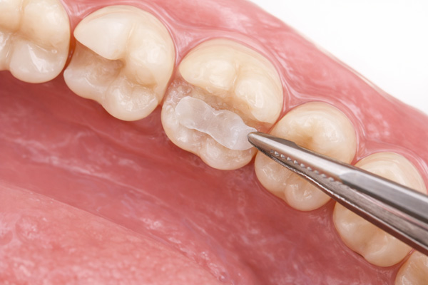 Incrustación dental